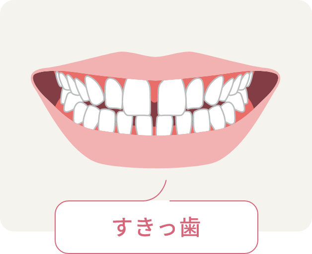 すきっ歯
