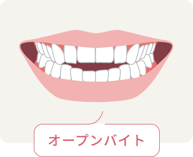 オープンバイト