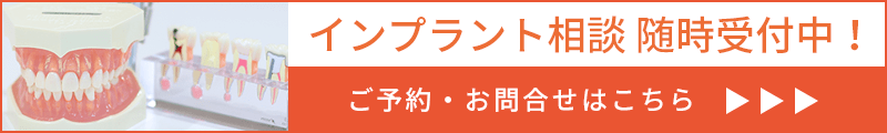 インプラント相談、随時実施中！