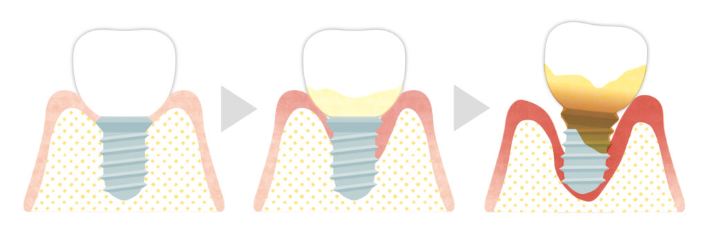インプラント周囲炎とは？予防策について解説